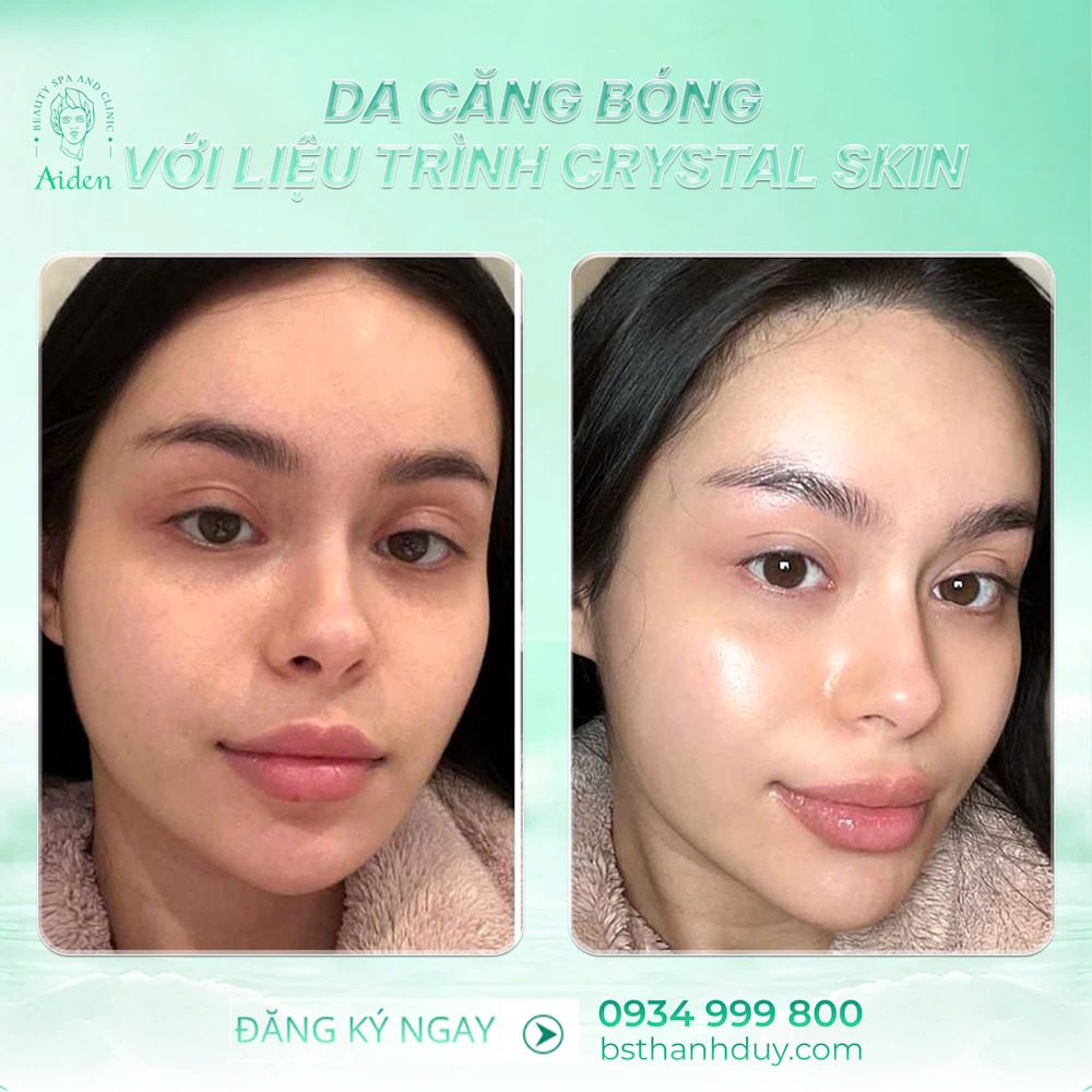 Căng bóng da giá bao nhiêu