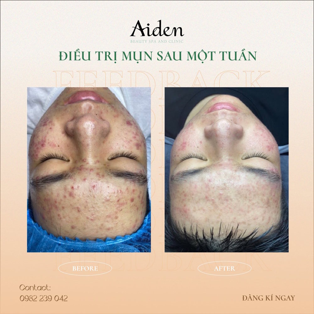 điều trị mụn viêm