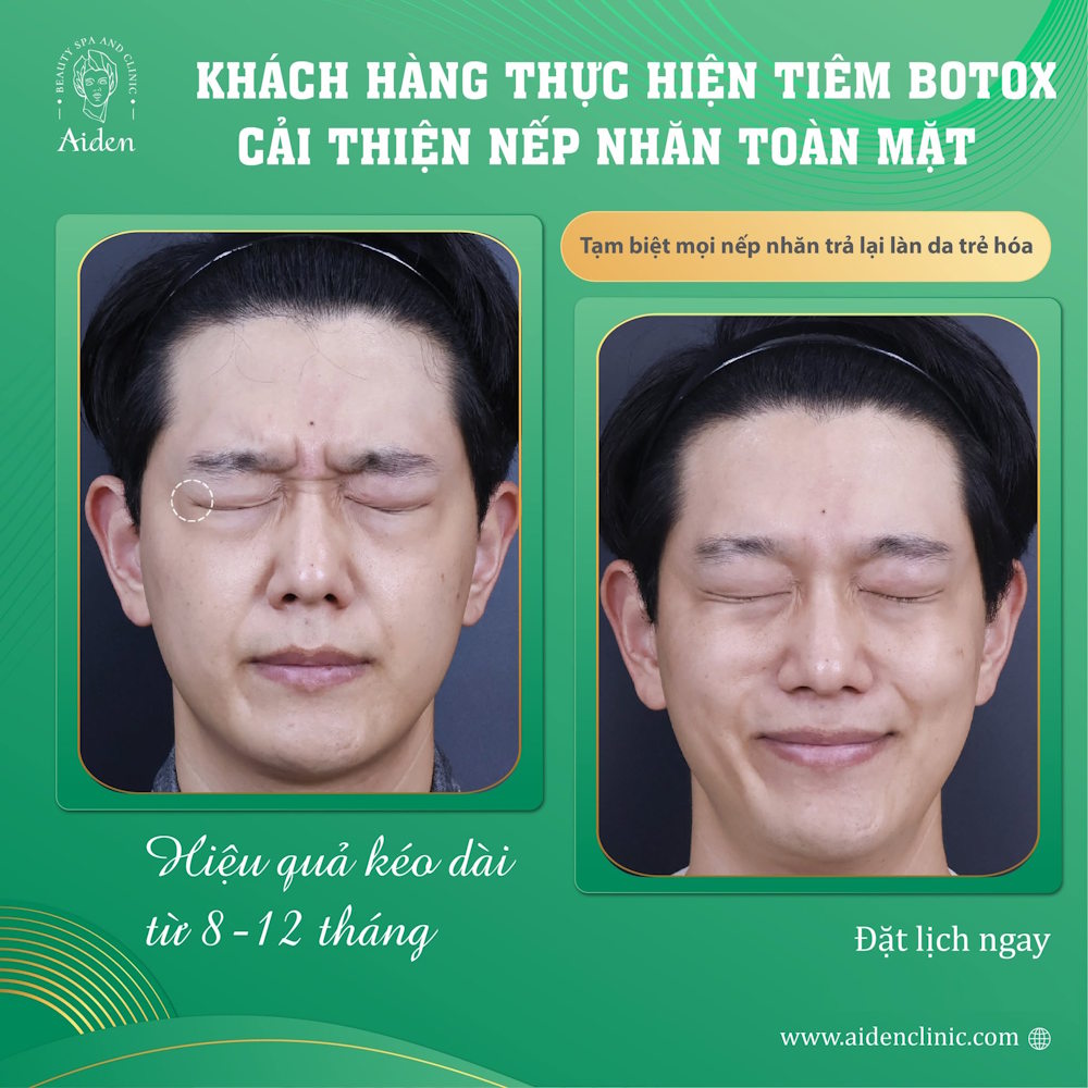 Botox forehead lines