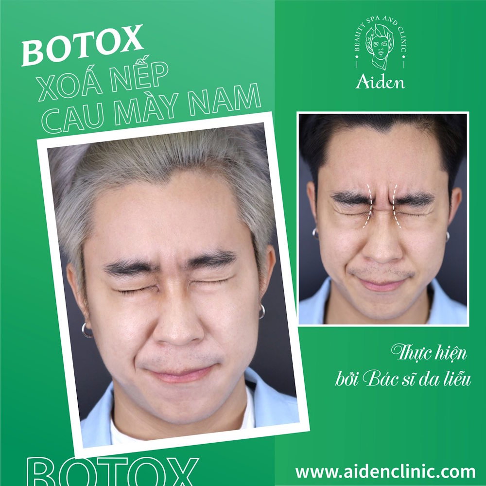 Botox forehead lines