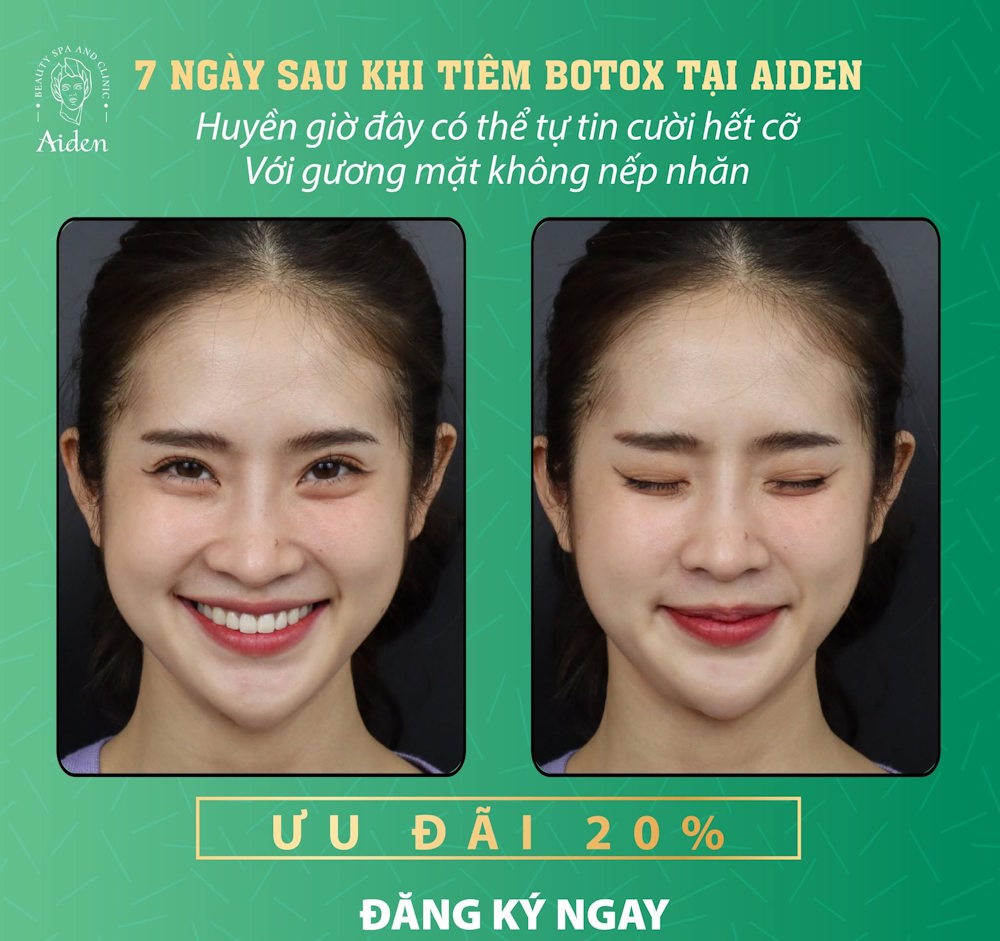 Botox forehead lines