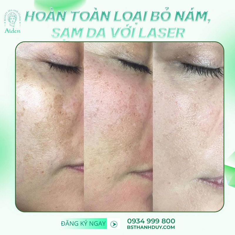 Effective Laser Treatment for Melasma