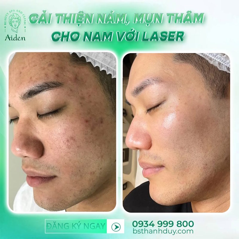 Effective Laser Treatment for Melasma