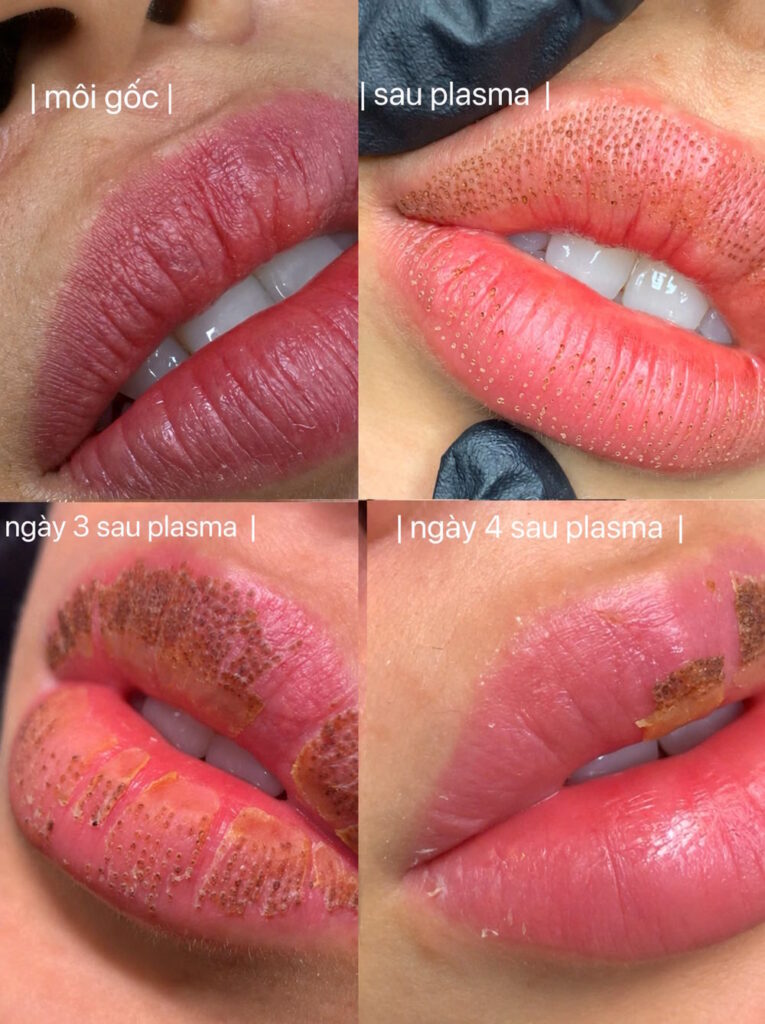 Plasma Lip Rejuvenatio