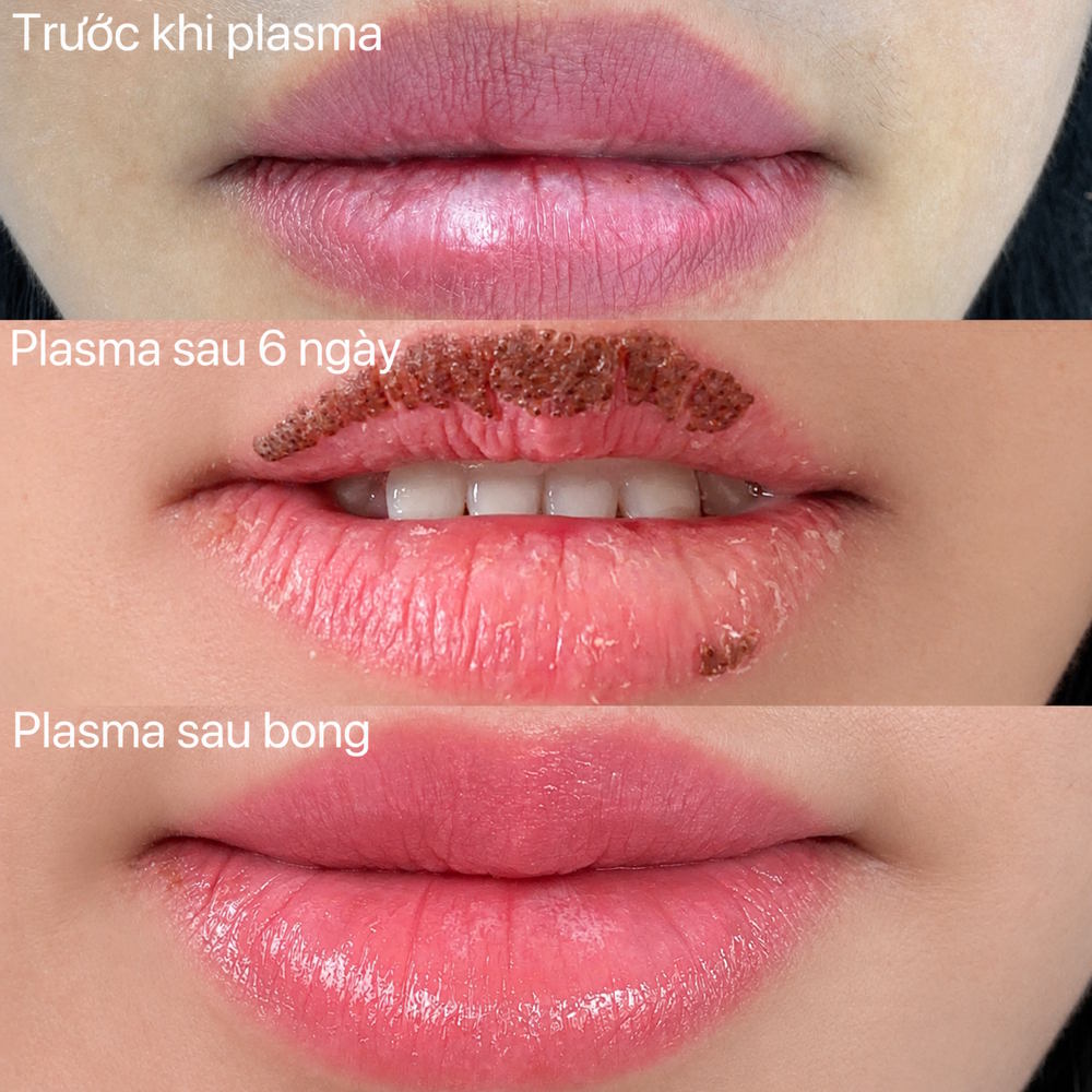 Plasma Lip Rejuvenatio