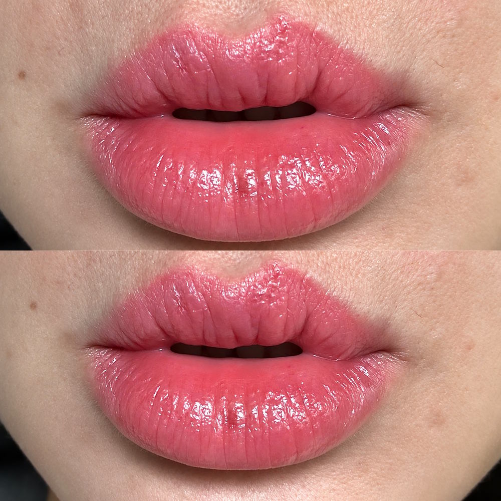 Plasma Lip Rejuvenatio